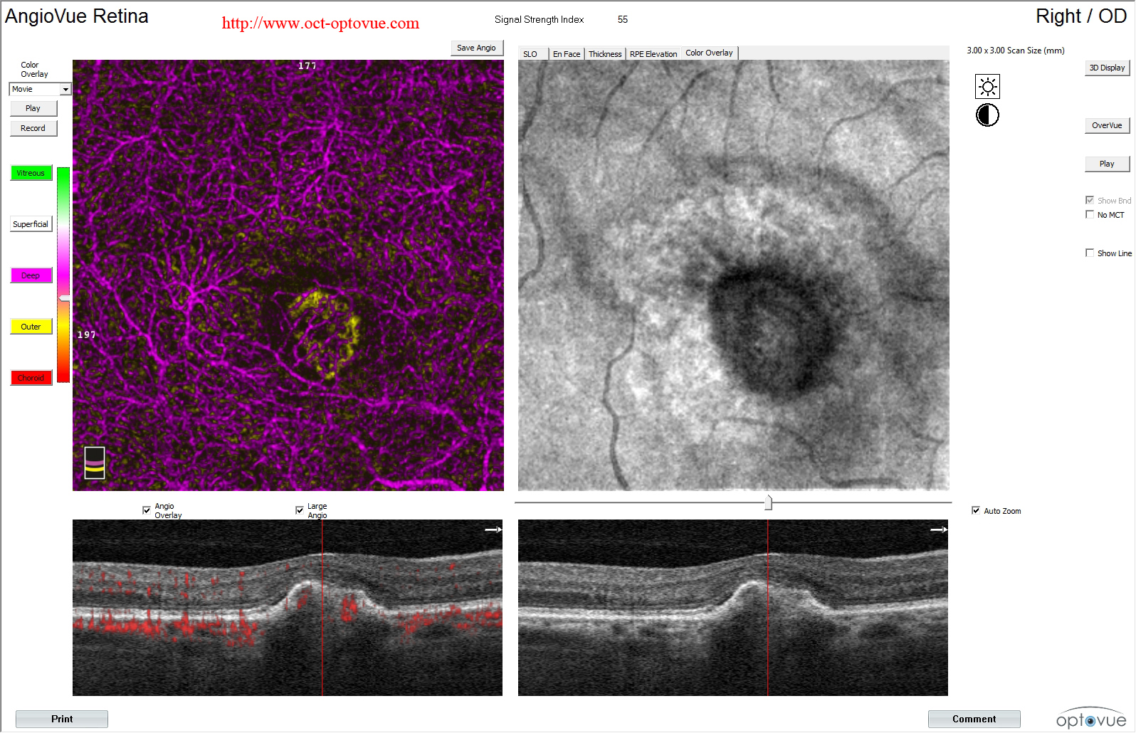 AMD color overlay oct angiography Optovue 
