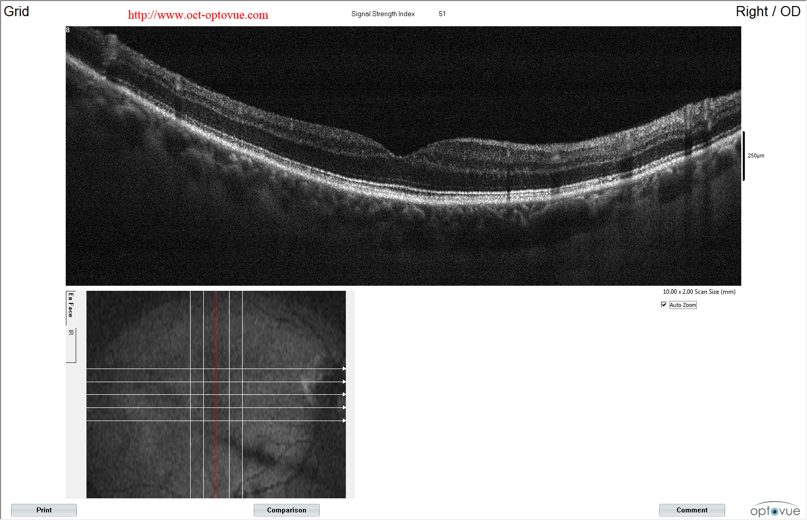 AION NOIAA OPTICAL COHERENCE TOMOGRAPHY