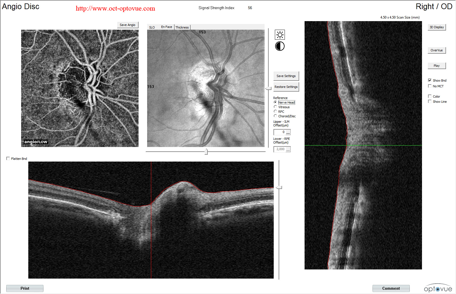 AION angiography-OCT