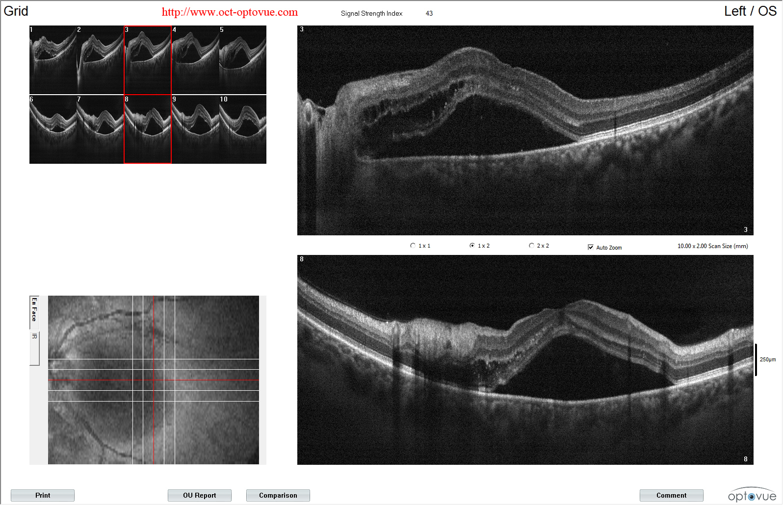 hypertensive retinopathy oct