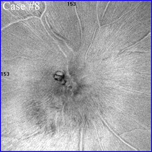optic-neuropathy-304