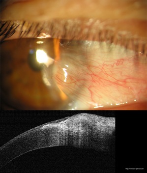 oct pterygion cornée cornea eye