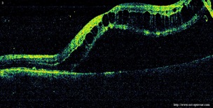 retinal detachment oct decollement retine