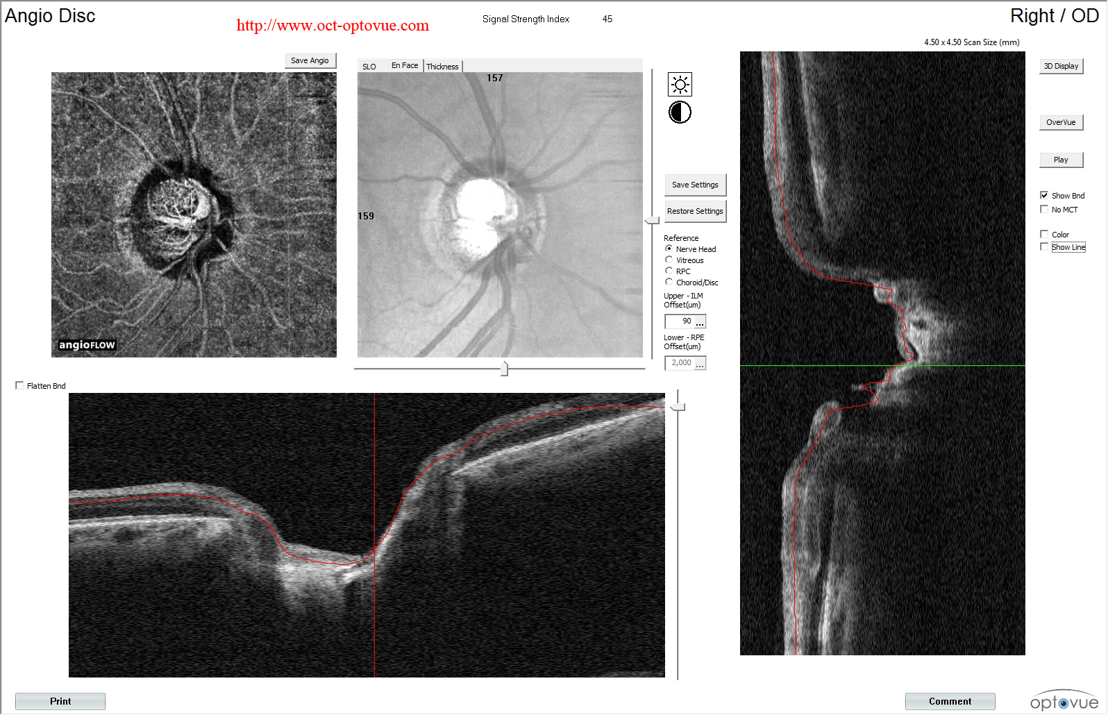 glaucoma optical coherence tomography
