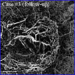 arterialisation cnv follow-up