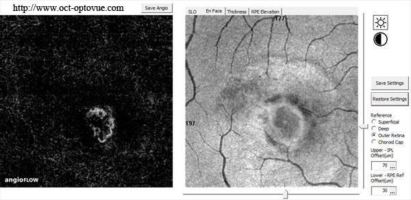 beacon-in-fog CNV oct-angiography