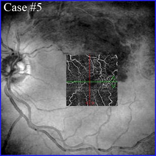 brvo oct-angiography