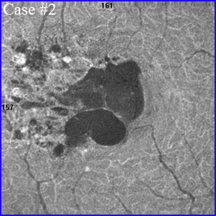 coats disease mactel 1 telangiectasia