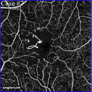 diabetes angio-optical coherence tomography