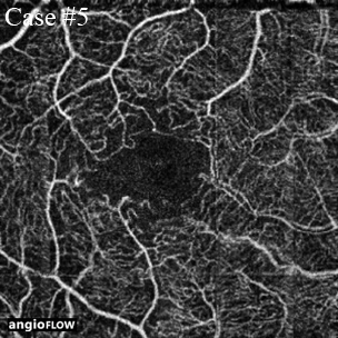 diabetes oct angiography 304