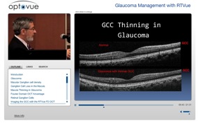 glaucoma management oct gcc
