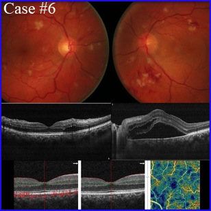 hypertensive retinopathy oct angiography