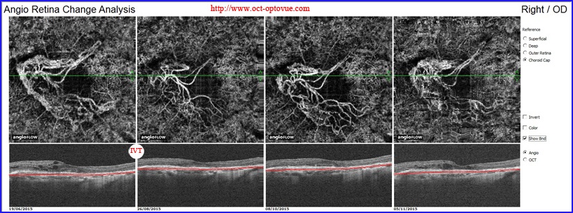 oct angiography new-cnv recurrent recurrence