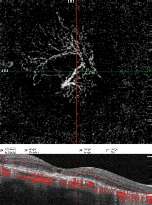 Projection Artifact Removal on