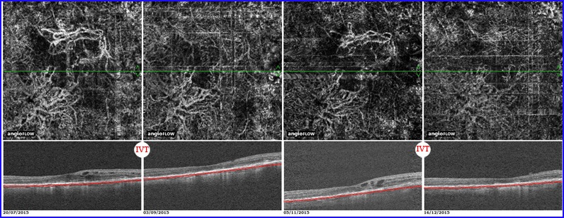 recurrent-cnv-retina recidive de neovaisseaux dmla