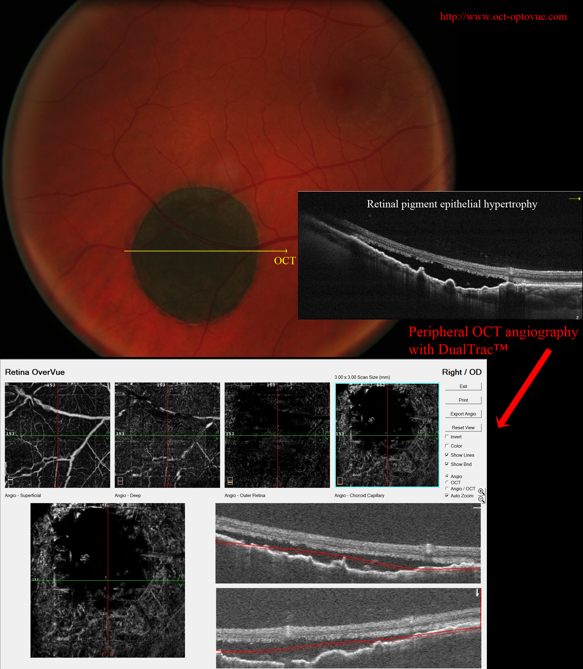 rpe hypertrophy dualtrac retinal pigment epithelial