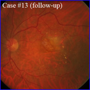 rpe-tears-followup