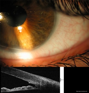 oct embryotoxon glaucome glaucoma