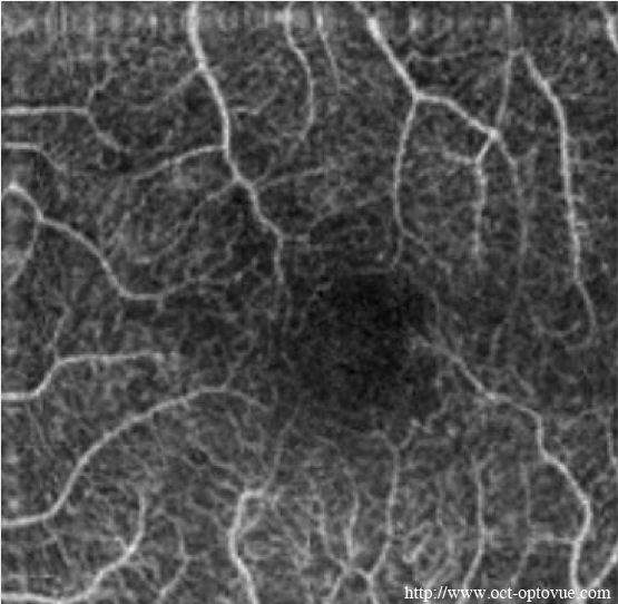 angio-oct-diabetic macula retinopathy