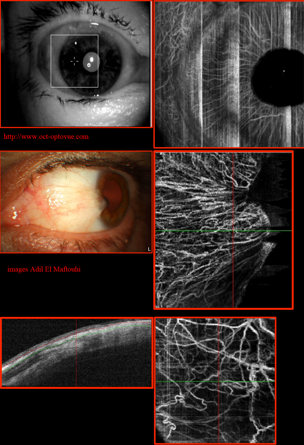 angio-oct- iris cornea cornée
