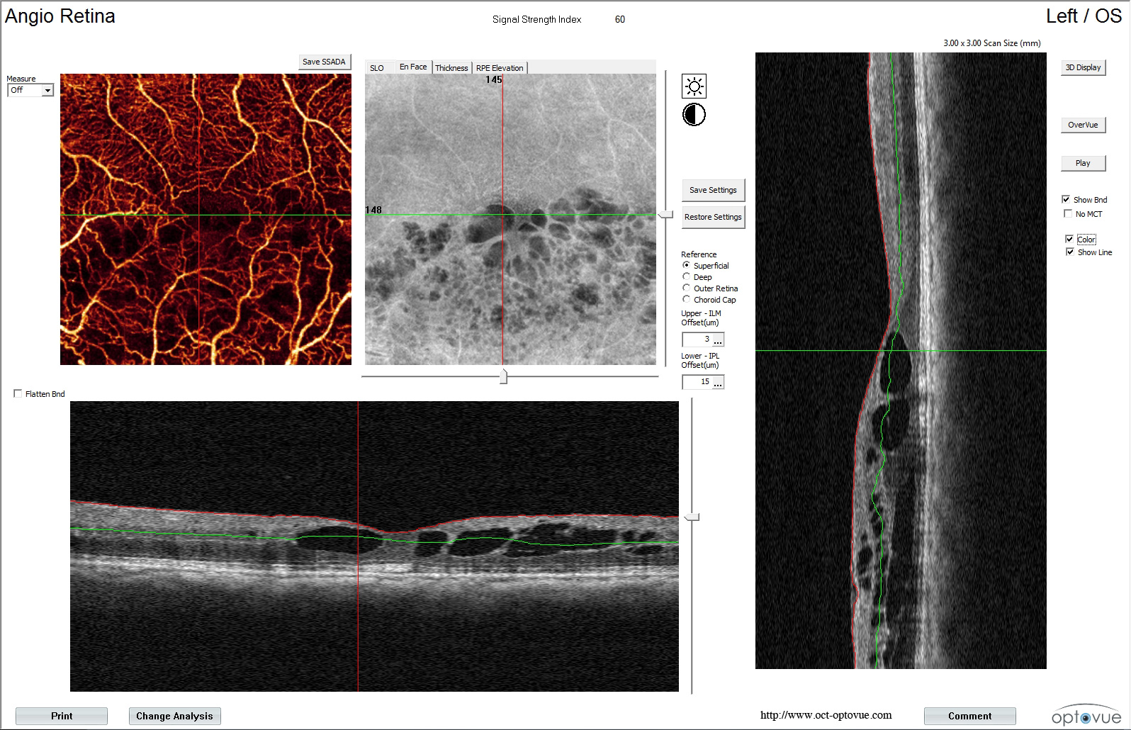 angio-oct-xr avanti maille capillaire optovue