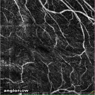 artifact oct-angiography eye motion mouvement oeil
