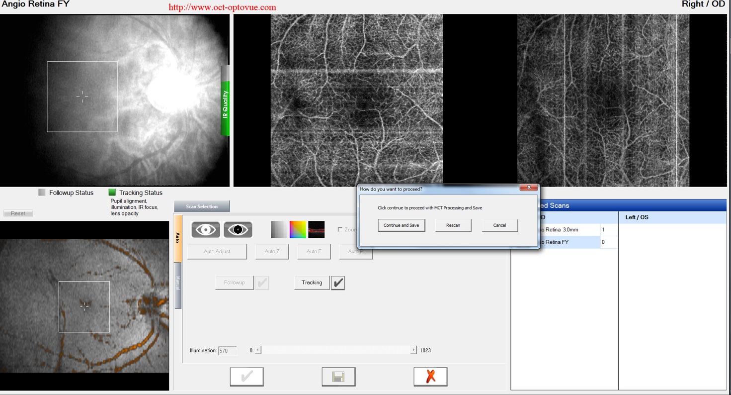 dualtrac optovue motion correction oct-angiography