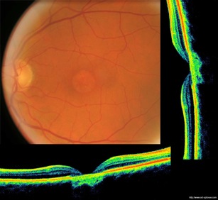 dystrophie aréolaire fo dmla armd retina