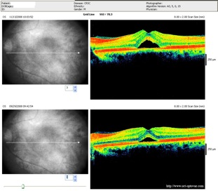 crsc crcs evolution aggravation retine