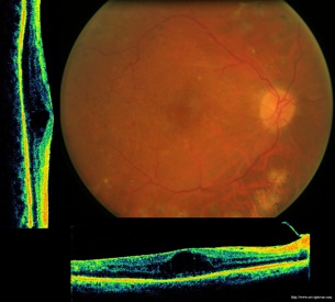 diabete diabetic retinopathy retinopathie oct epiretinal