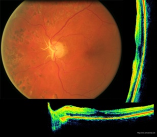 rétinopathie diabétique ppr oct diabetic retinopathy laser