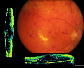 oct diabetic retinopathy oedema diabetique