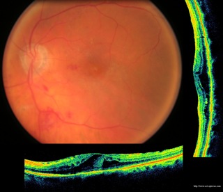 diabete diabetic retinopathy retinopathie oct
