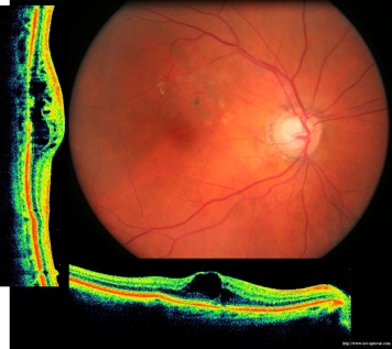 cicatrice lucentis dmla armd ivt retina retine