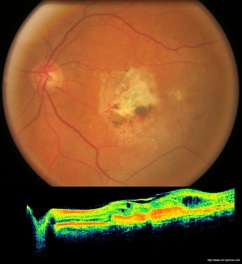 oct armd dmla retine dégénérescence maculaire