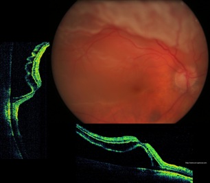 décollement rétine retina detachment oct optovue