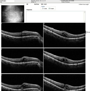 oedeme rétinien oedema retina oct optovue