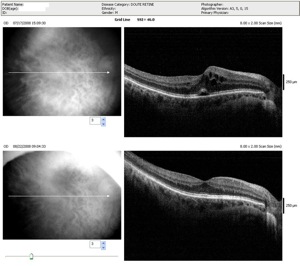 omc traité évolution oedème rétinien retina oct optovue