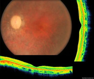 pigmentosa retinopathy oct retinopathie pigmentaire