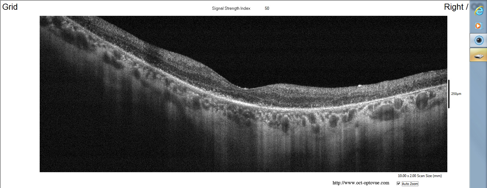retinitis pigmentosa xr pigmentaire