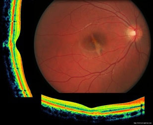 contusion rpe retine retina trauma oct