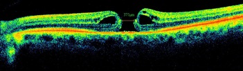trou maculaire retina optovue oct hole
