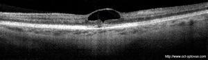 kyste foveolaire trou maculaire retina 