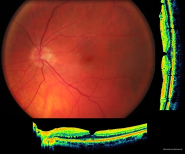 oct pseudo macular hole trou maculaire