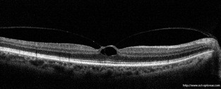 macular traction maculaire oct