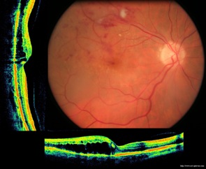 occlusion branche veine centrale retine retina oct optovue