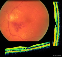 occlusion branche veine centrale retine retina oct optovue