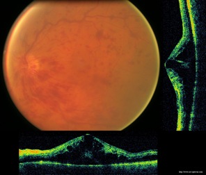ovcr oedeme retine retina oedema occlusion oct optovue