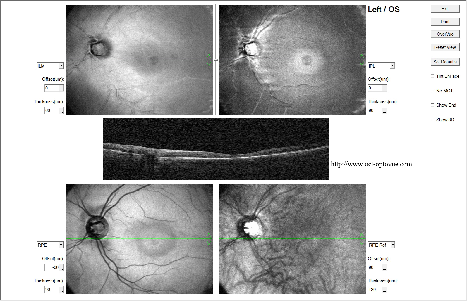 oct-enface-plaquenil oeil de boeuf hydroxychloroquine