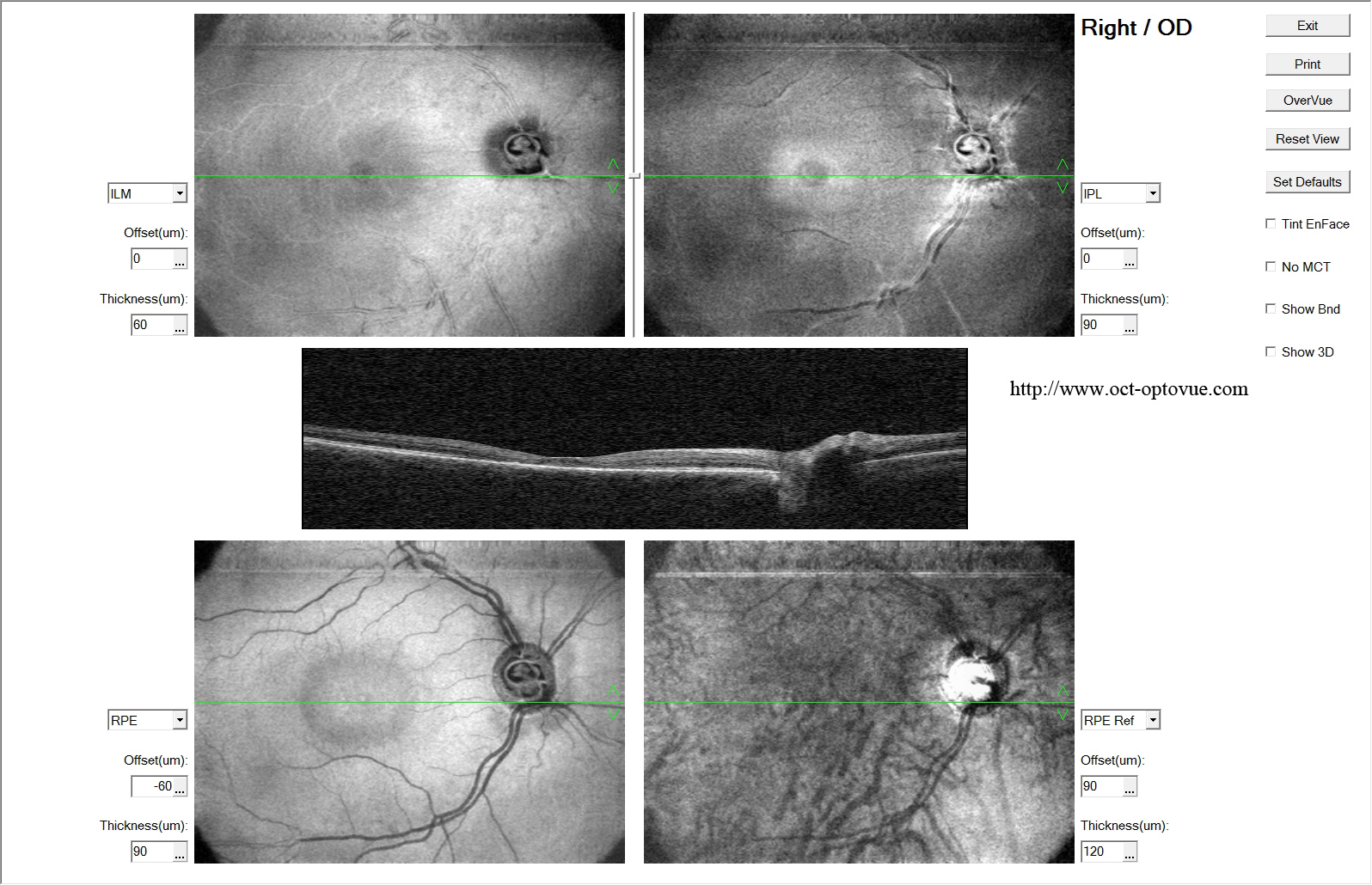 oct plaquenil retine retina hydroxychloroquin